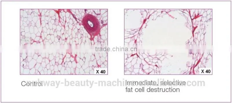 Ultrasound HIFU Liposonix Body Contouring Shaping With Fast Effect