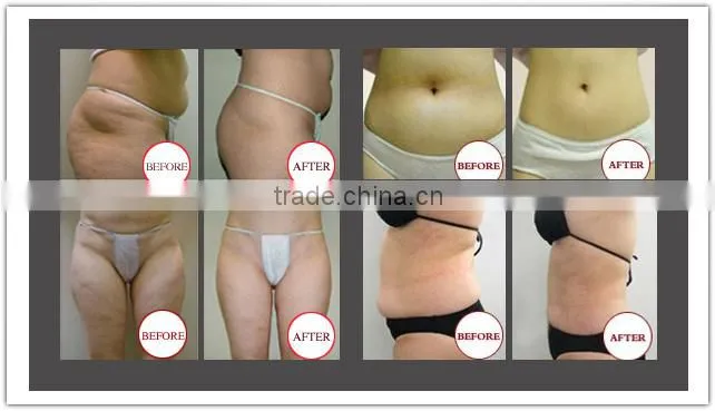 Professional cellulite massage machines/roller facial vacuum suction machine/cellulite roller massage