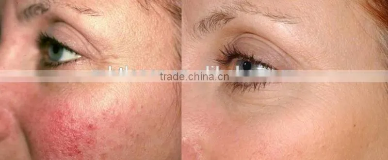 Best Quality Made In China 980nm Medical Diode Laser Spider Vein Removal Machine