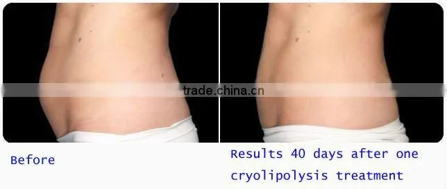 best cool slimming machine