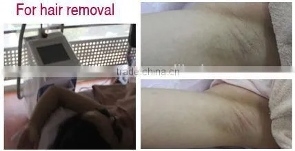 ND yag long pulsed laser hair removal/ 532NM spider vein treat machine