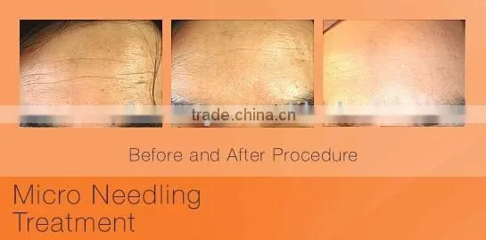 OEM acceptable microneedle roller stretch marks
