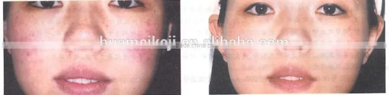 Chinese IPL hair removal from HUAMEI HM-IPL-B1