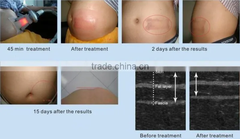 freezing fat cell slimming machine/cryo slimming machine/fat freeze slimming machine