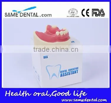 Dental Implant Practice Model With Gingival School Teaching Demonstration Models