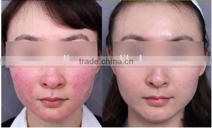Diode Laser Spider Veins Removal Skin Care Device