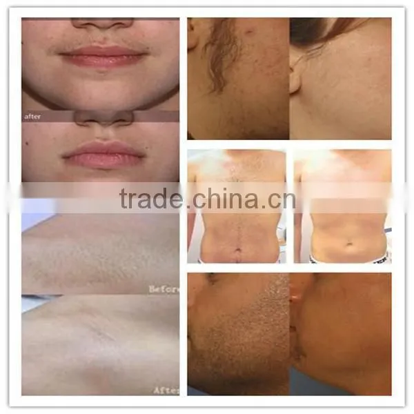 808nm 1-10Hz Diode Laser Back Hair Removal Machine Price