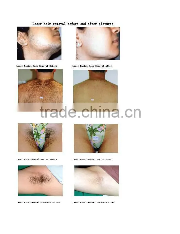beauty salon equipment laser 808 diode hair removal DH 03N
