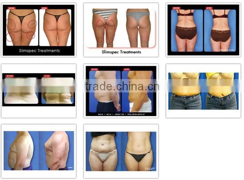 Best ultrasonic cavitation machine for cellulite loss