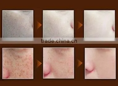 Professional elight best professional ipl machine for hair removal