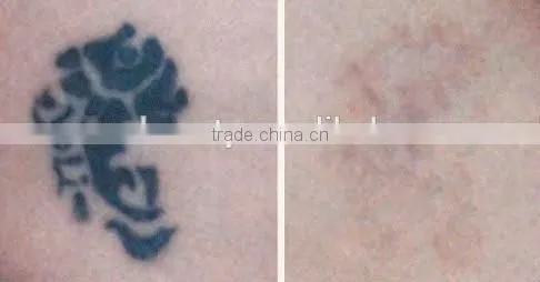 2016 Hottest Home Laser tattoo removal q switch nd yag laser-vascular