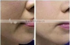 Professional Latest Portable IPL Beauty Machine FP-Laser