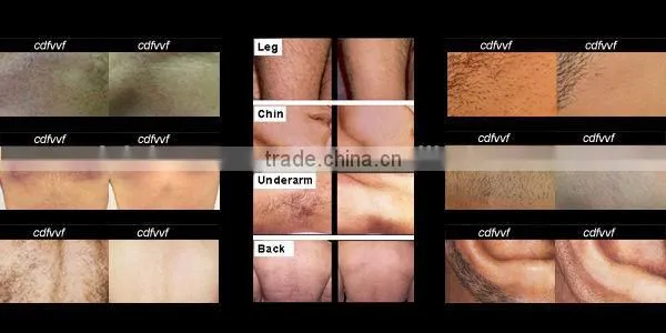 diode laser therapy device,bikini diode laser,808 diode laser beauty equipment