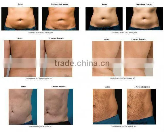 HEMS Low Price Cavitation RF Fat Loss /Cavitation RF Slimming Machine