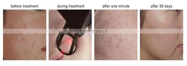 Popular Style!! Skin Rejuvenation Laser Vaginal Tightening Device CO2 Laser Fractional Machine with CE
