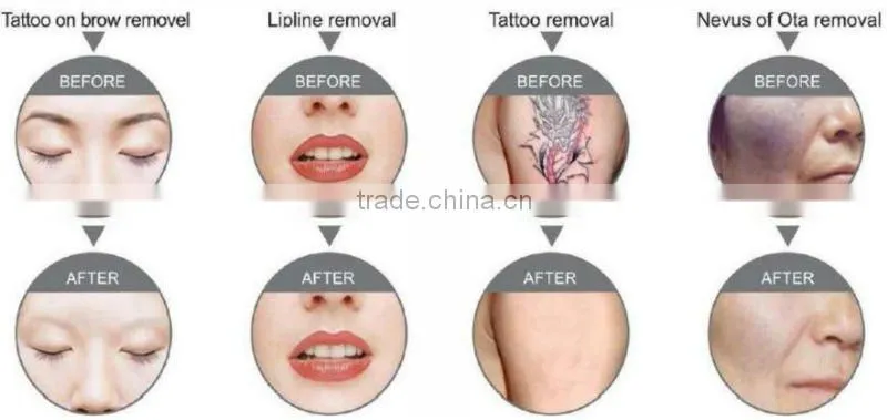 Effective nd yag laser tattoo removal machine