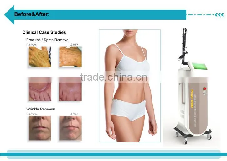 Good effect CO2 fractional laser skin spot removal wrinkle removal vaginal care machine--CV-I