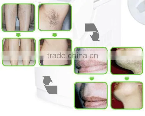 12 months warranty Painless permanent super hair removal ipl machine