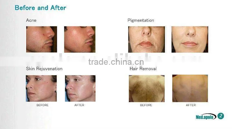 newest products 2014 beauty elight facial machine 2014 beauty product by china manufacturer shanghai med apolo medical tech