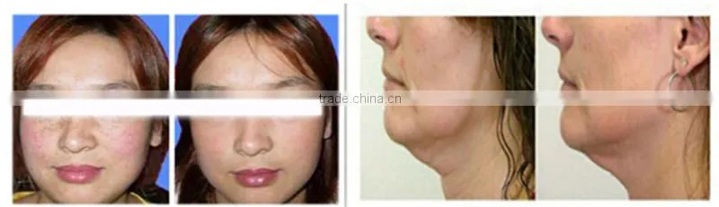 Hot New Products For 2014 Radio Frequency Best Skin Tightening Machine
