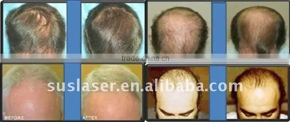 2013 hot! wholesale suslaser hair loss treatment machine BL005 CE/ISO suslaser hair loss treatment machine