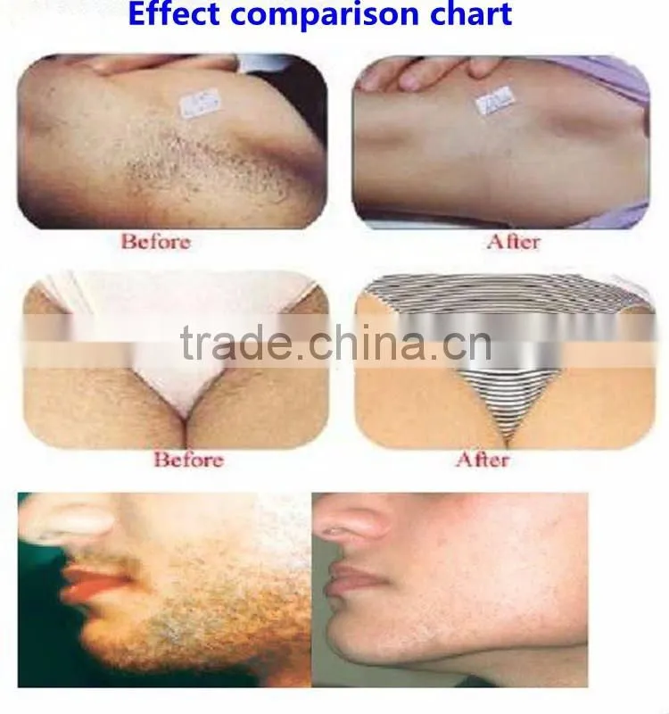 Medical 808nm vacuum slimming machine Hair Removal Machine