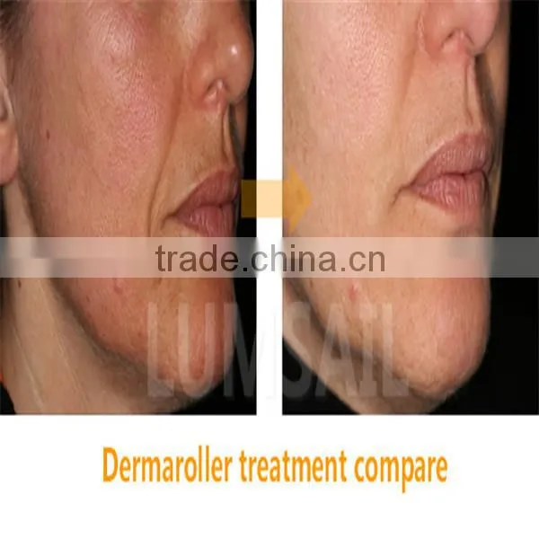 New arrival Derma Roller titanium needle 540 DEEDLE derma roller 0.5 mm derma roler