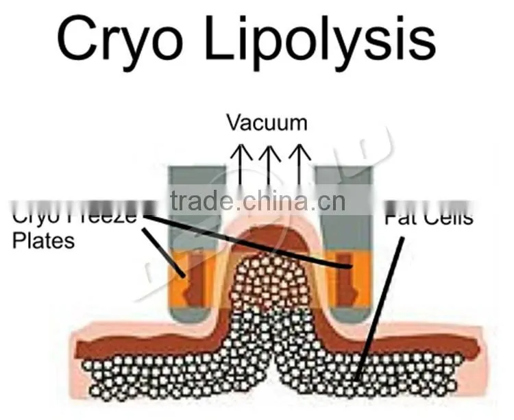 Venus freeze criolipolisis fat freezing cryolipolysis machine ce