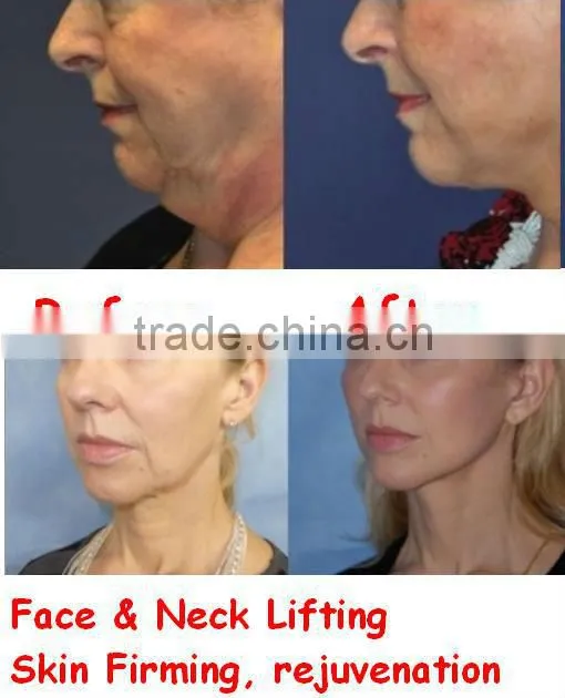 Cavitation Professional Beauty Fractional RF Facial Beauty & Body Shaping - DOUBLO