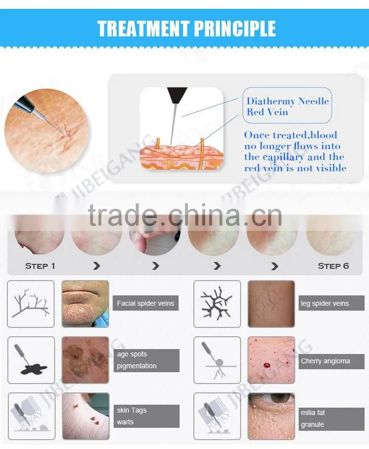 New arrival best treatment portable painless blood vessel removal laser home remedies for spider varicose veins removal machine