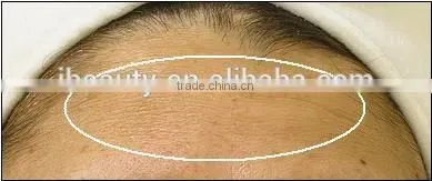 2016 MR16-2SB New product microneedle /auto micro needle therapy system