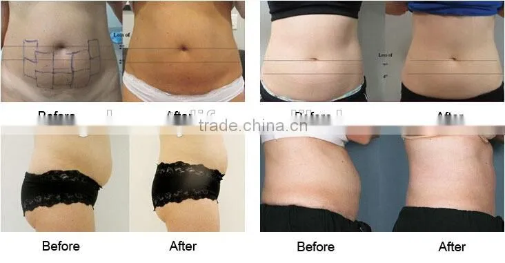 hifu slimming machine 2016
