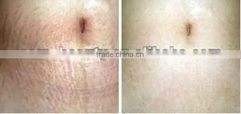 Facial beauty roller injectable collagen skin nurse wrinkles eliminate L010