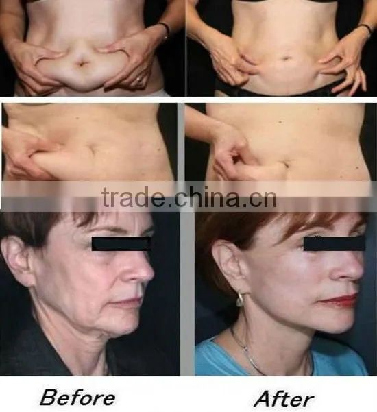 HEMS Weight loss body rejuvenation system cryo cold