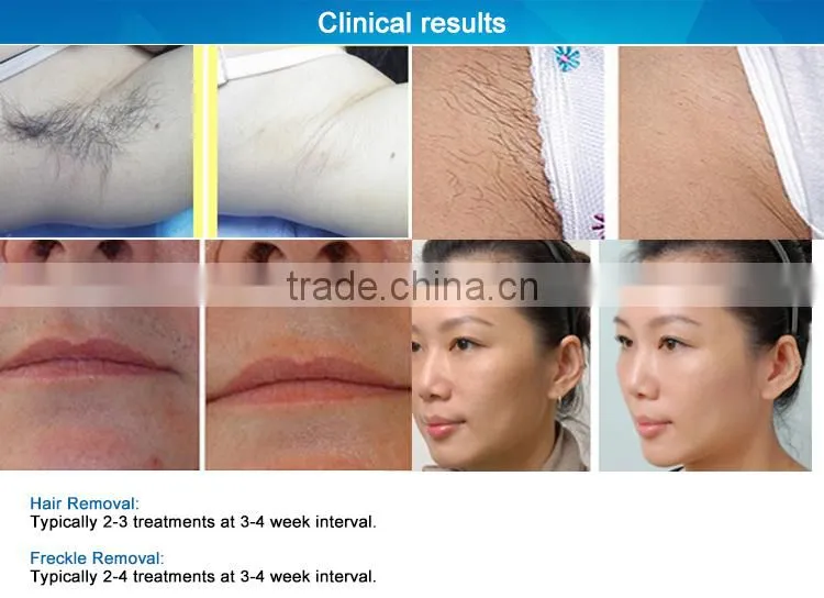 salon equipment 808nm diode laser hair removal