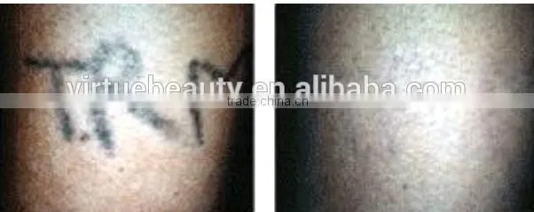 Long pulsed ND YAG laser for tattoo removal