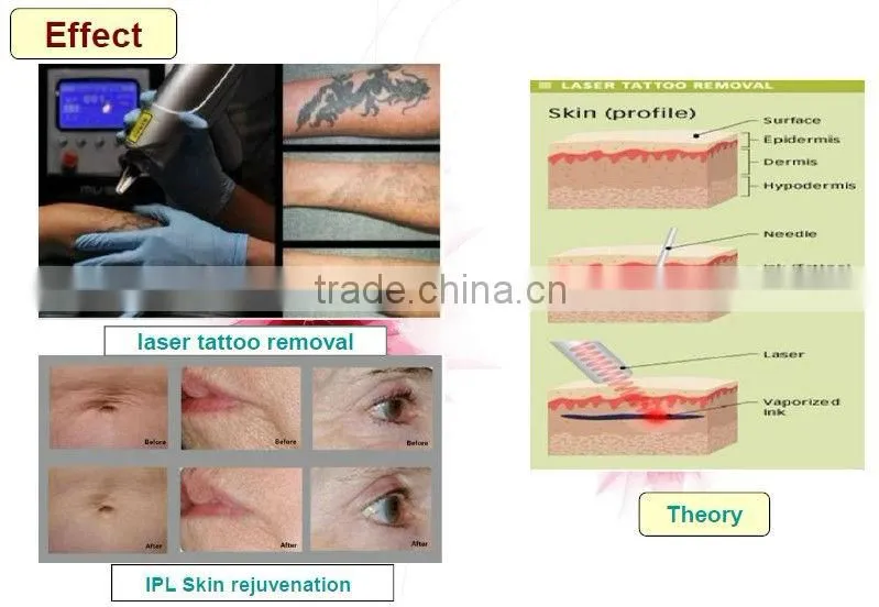 Best price !! diode laser hair removal machine for sale