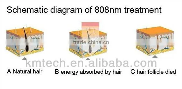 Best fda approved laser hair removal machine for sale