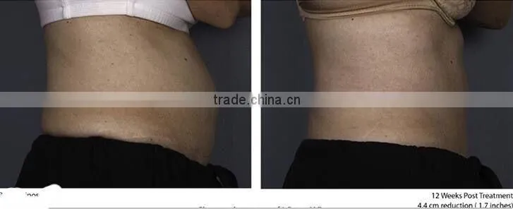 New fat killer HIFU slimming machine