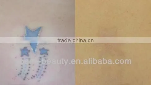 Mini Q-switch ND Yag laser tattoo removal machine D003