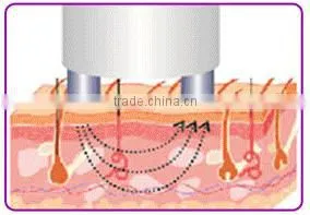 Home use radio frequency treatment
