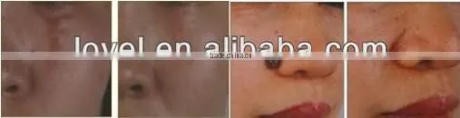 100% High Quality Skin Resurfacing Acne Scar Removal Fractional Co2 Laser Equipment