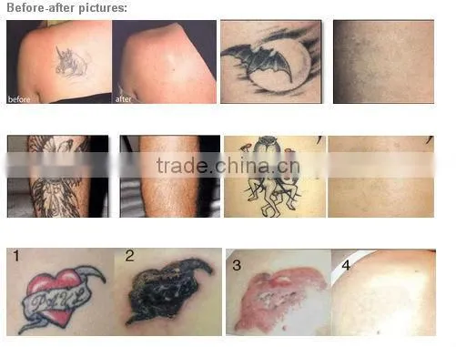 Top quality rejuvi tattoo removal/tattoo removal machine/professional laser tattoo removal machine