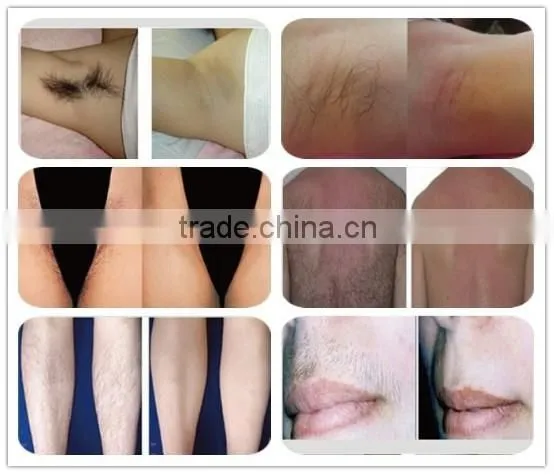 hair removal laser machines / laser hair removal eyebrows / laser hair removal turkey