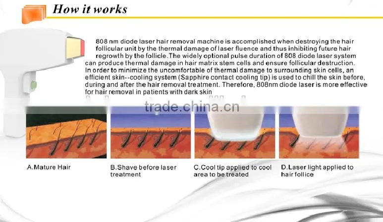 professional depilacion pain free permanent hair removal 808nm diode laser machine speed 808