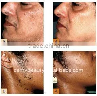 Beauty salon equipment professional long pulse laser remove hair machine-P003