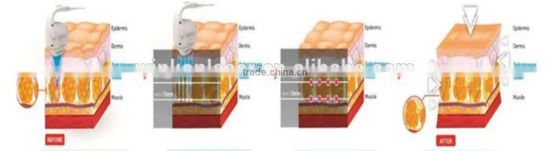 cavitation hifu slim machine / High Quality Hifu