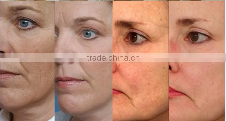 High Frequency Operation System and Anti-Puffiness/Skin Tightening/Wrinkle Remover Feature HIFU Face Lift