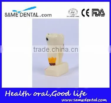 Dental Model School Teaching Dental Eduction Assitant No. DEA-15 4 times Integrated Pathology Model