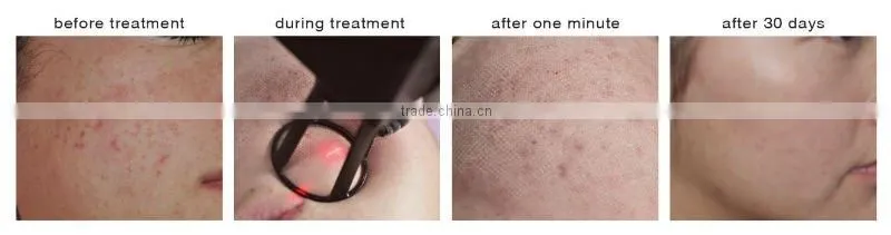 F5 Hot sell Co2 fractional laser used beauty salon equipment for sale